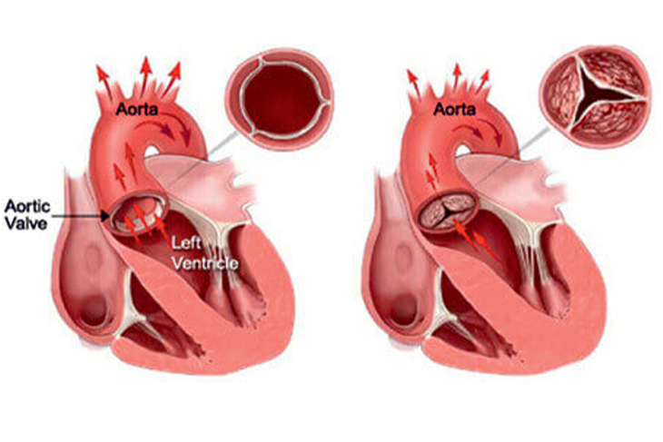 CATHETER-BASED VALVE IMPLANTATIONS (TAVI/TAVR) by Dr. Nagesh Waghmare, Interventional Cardiologist & Heart Specialist in Mumbai, India.