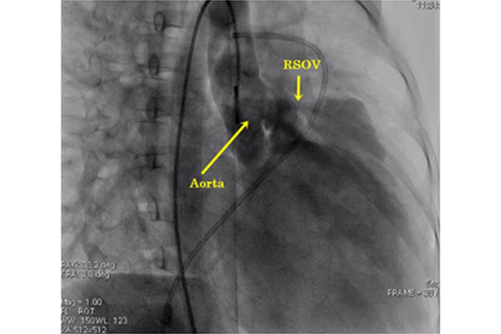 RSOVA CLOSURE WITH DEVICES/COIL by Dr. Nagesh Waghmare, Interventional Cardiologist & Heart Specialist in Mumbai, India.