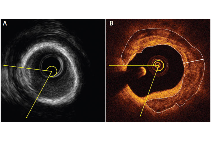 INTRA-VASCULAR IMAGING (OCT AND IVUS) by Dr. Nagesh Waghmare, Interventional Cardiologist & Heart Specialist in Mumbai, India.