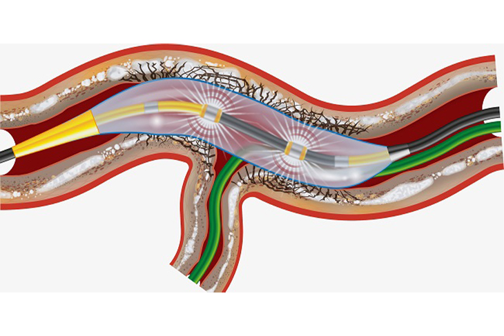 INTRA-VASCULAR LITHOTRIPSY by Dr. Nagesh Waghmare, Interventional Cardiologist & Heart Specialist in Mumbai, India.